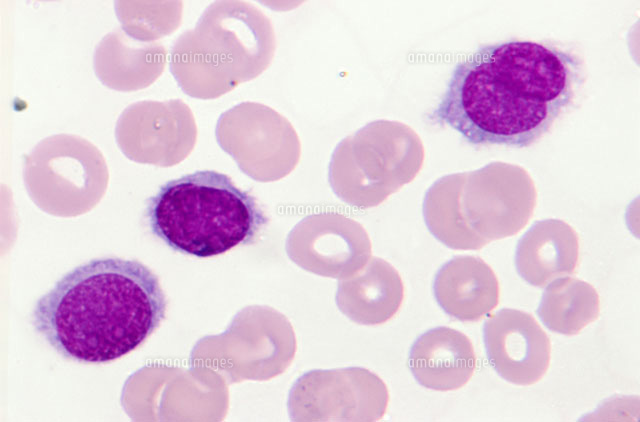 有毛細胞白血病 の写真素材 イラスト素材 アマナイメージズ 有毛細胞白血病 の写真素材 イラスト素材 アマナイメージズ