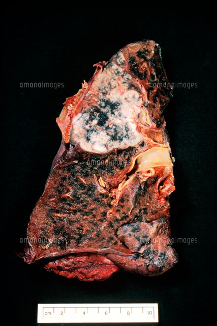 肺癌 の写真素材 イラスト素材 アマナイメージズ