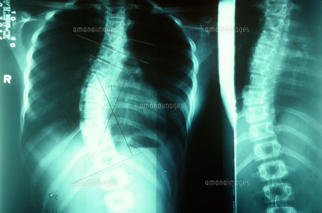 脊柱側弯症 の写真素材 イラスト素材 アマナイメージズ