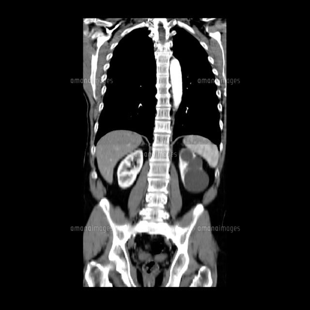 良性嚢胞のある胸部のｃｔ の写真素材 イラスト素材 アマナイメージズ