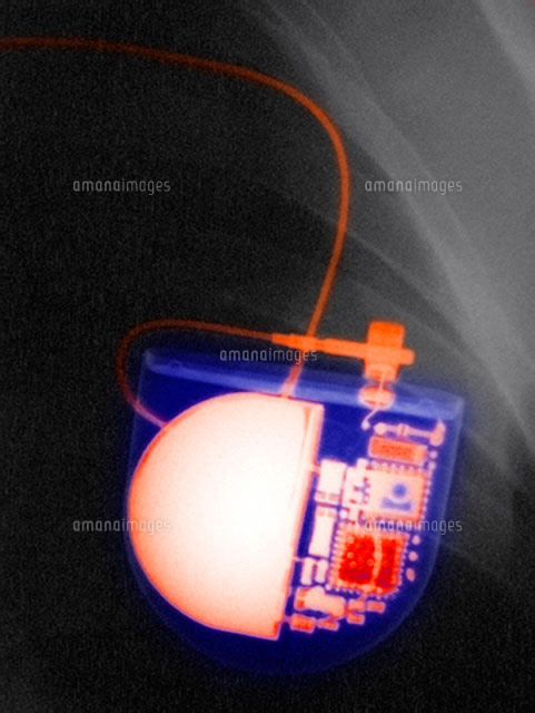 ペースメーカー の写真素材 イラスト素材 アマナイメージズ