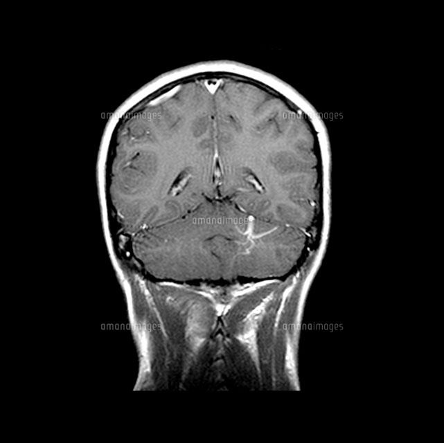 小脳の静脈性血管奇形[01808023555]の写真素材・イラスト素材｜アマナ 