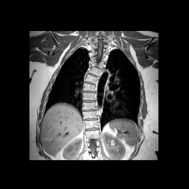 胸郭原性脊柱側弯症mri の写真素材 イラスト素材 アマナイメージズ