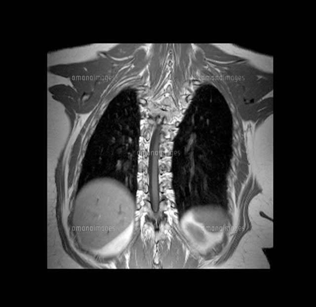 胸郭原性脊柱側弯症mri の写真素材 イラスト素材 アマナイメージズ 胸郭原性脊柱側弯症mri の写真素材 イラスト素材 アマナイメージズ