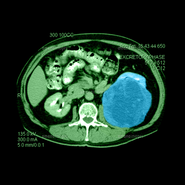 Ct Of Abdomen Large Renal Carcinoma 01808030135 の写真素材 イラスト素材 アマナイメージズ