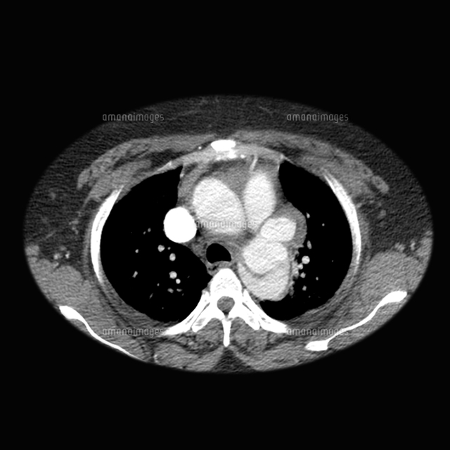 Aortic Dissection Ct の写真素材 イラスト素材 アマナイメージズ