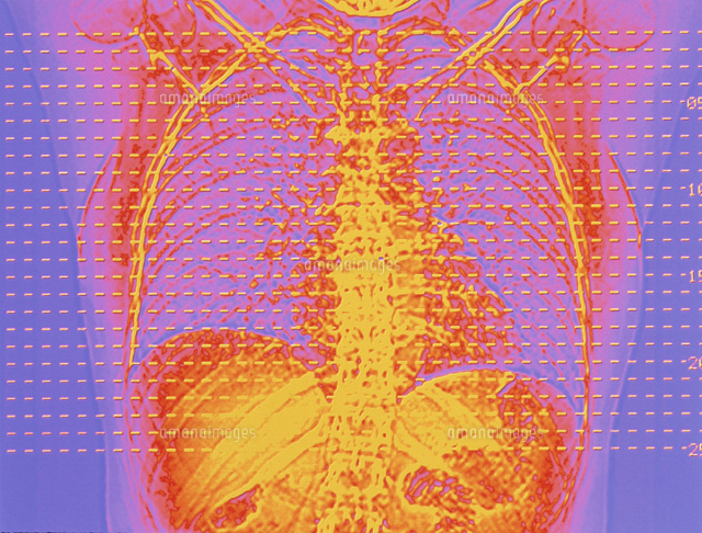 肺と心臓のctスキャン の写真素材 イラスト素材 アマナイメージズ