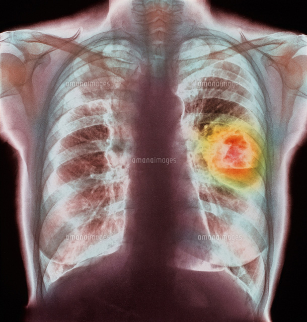 肺癌のレントゲン写真 の写真素材 イラスト素材 アマナイメージズ