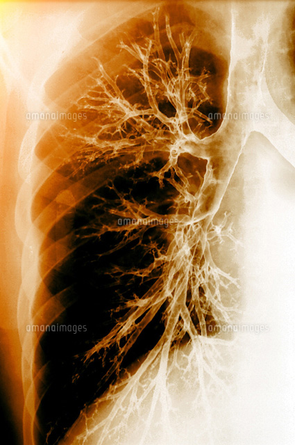 肺 の写真素材 イラスト素材 アマナイメージズ