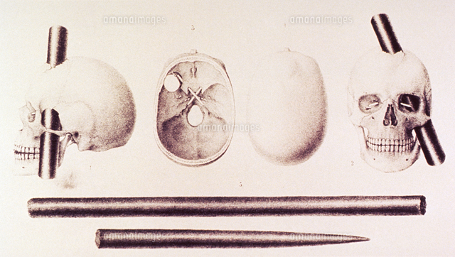 フィニアス ゲージの頭部外傷 1848年 リトグラフ の写真素材 イラスト素材 アマナイメージズ