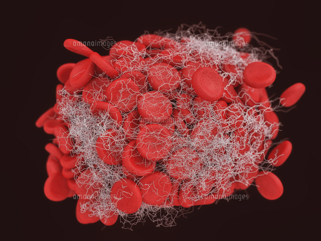 Illustration of a blood clot showing a clump of red blood cells