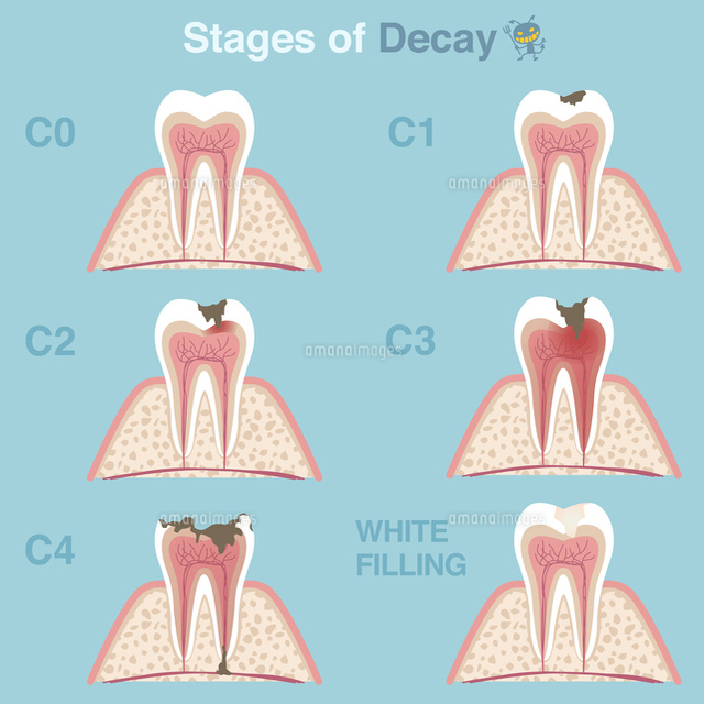 虫歯の進行 の写真素材 イラスト素材 アマナイメージズ