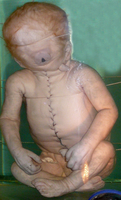 viscera infest 奇形児単眼症 Cyclopia in human. Photo of a visiting exhibit from St